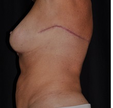 Body Contouring After Photo by Michael Frederick, MD; Fort Lauderdale, FL - Case 35894
