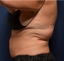 Body Contouring Before Photo by Michael Frederick, MD; Fort Lauderdale, FL - Case 35894