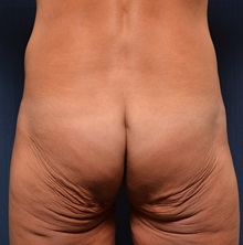 Body Lift Before Photo by Michael Frederick, MD; Fort Lauderdale, FL - Case 35895
