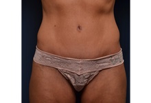 Body Lift After Photo by Michael Frederick, MD; Fort Lauderdale, FL - Case 35895