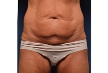 Body Lift Before Photo by Michael Frederick, MD; Fort Lauderdale, FL - Case 35895