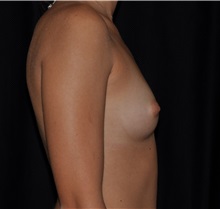 Breast Augmentation Before Photo by Michael Frederick, MD; Fort Lauderdale, FL - Case 35896