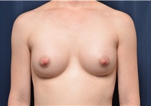 Breast Augmentation After Photo by Michael Frederick, MD; Fort Lauderdale, FL - Case 35897