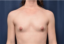 Breast Augmentation Before Photo by Michael Frederick, MD; Fort Lauderdale, FL - Case 35897