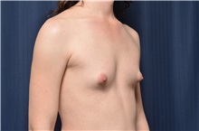 Breast Augmentation Before Photo by Michael Frederick, MD; Fort Lauderdale, FL - Case 35897