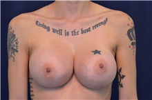 Breast Augmentation After Photo by Michael Frederick, MD; Fort Lauderdale, FL - Case 35898