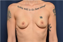 Breast Augmentation Before Photo by Michael Frederick, MD; Fort Lauderdale, FL - Case 35898