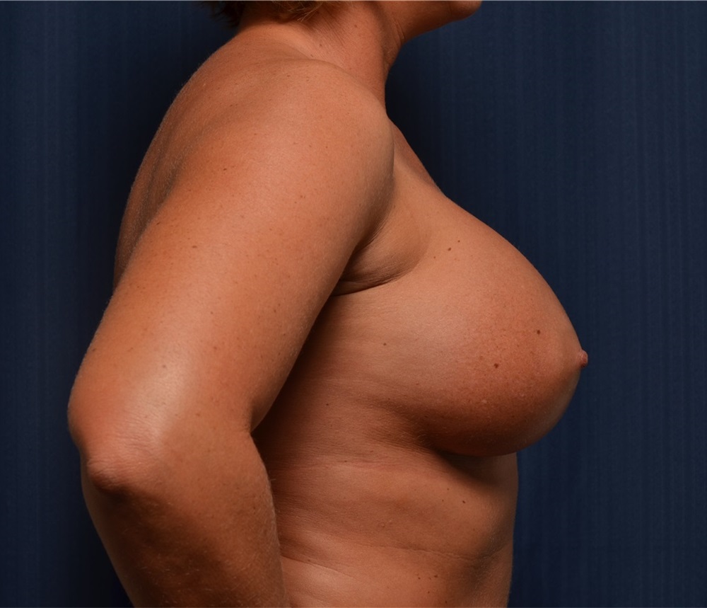 Breast Implants in Ft. Lauderdale, FL