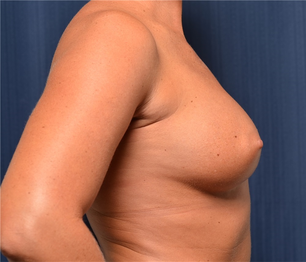 Breast Implants in Ft. Lauderdale, FL