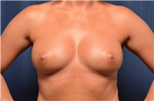 Breast Augmentation Before Photo by Michael Frederick, MD; Fort Lauderdale, FL - Case 35899