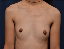 Breast Augmentation Before Photo by Michael Frederick, MD; Fort Lauderdale, FL - Case 35901