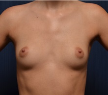Breast Augmentation Before Photo by Michael Frederick, MD; Fort Lauderdale, FL - Case 35902