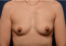 Breast Augmentation Before Photo by Michael Frederick, MD; Fort Lauderdale, FL - Case 35904