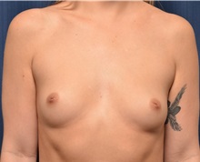 Breast Augmentation Before Photo by Michael Frederick, MD; Fort Lauderdale, FL - Case 35906