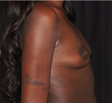 Breast Augmentation Before Photo by Michael Frederick, MD; Fort Lauderdale, FL - Case 35908