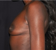 Breast Augmentation Before Photo by Michael Frederick, MD; Fort Lauderdale, FL - Case 35908