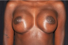 Breast Augmentation After Photo by Michael Frederick, MD; Fort Lauderdale, FL - Case 35908