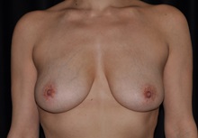 Breast Lift Before Photo by Michael Frederick, MD; Fort Lauderdale, FL - Case 35909
