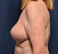 Breast Lift After Photo by Michael Frederick, MD; Fort Lauderdale, FL - Case 35910
