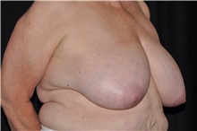Breast Lift Before Photo by Michael Frederick, MD; Fort Lauderdale, FL - Case 35911