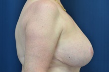 Breast Lift After Photo by Michael Frederick, MD; Fort Lauderdale, FL - Case 35911