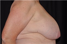 Breast Lift Before Photo by Michael Frederick, MD; Fort Lauderdale, FL - Case 35911