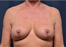 Breast Lift After Photo by Michael Frederick, MD; Fort Lauderdale, FL - Case 35912