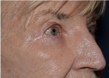 Eyelid Surgery After Photo by Michael Frederick, MD; Fort Lauderdale, FL - Case 35931