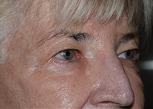 Eyelid Surgery Before Photo by Michael Frederick, MD; Fort Lauderdale, FL - Case 35931