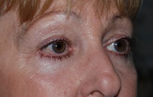 Eyelid Surgery After Photo by Michael Frederick, MD; Fort Lauderdale, FL - Case 35932
