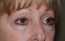 Eyelid Surgery Before Photo by Michael Frederick, MD; Fort Lauderdale, FL - Case 35932
