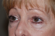 Eyelid Surgery Before Photo by Michael Frederick, MD; Fort Lauderdale, FL - Case 35932