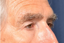 Brow Lift After Photo by Michael Frederick, MD; Fort Lauderdale, FL - Case 35933