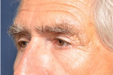 Brow Lift After Photo by Michael Frederick, MD; Fort Lauderdale, FL - Case 35933