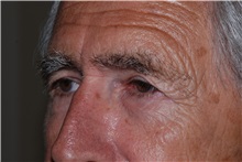 Brow Lift Before Photo by Michael Frederick, MD; Fort Lauderdale, FL - Case 35933