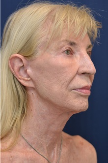 Facelift After Photo by Michael Frederick, MD; Fort Lauderdale, FL - Case 35936