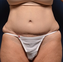 Body Lift Before Photo by Michael Frederick, MD; Fort Lauderdale, FL - Case 35940