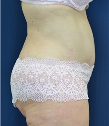 Body Lift After Photo by Michael Frederick, MD; Fort Lauderdale, FL - Case 35940