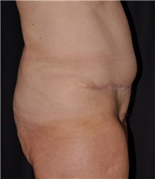 Body Lift Before Photo by Michael Frederick, MD; Fort Lauderdale, FL - Case 35940