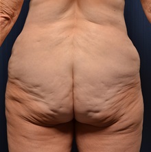 Body Lift Before Photo by Michael Frederick, MD; Fort Lauderdale, FL - Case 35940