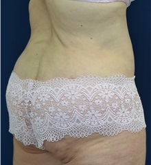 Body Lift After Photo by Michael Frederick, MD; Fort Lauderdale, FL - Case 35940