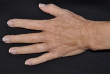 Hand Surgery After Photo by Michael Frederick, MD; Fort Lauderdale, FL - Case 35942