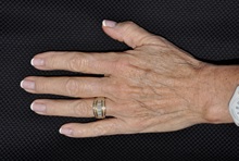 Hand Surgery Before Photo by Michael Frederick, MD; Fort Lauderdale, FL - Case 35942