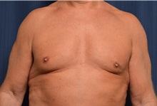 Male Breast Reduction After Photo by Michael Frederick, MD; Fort Lauderdale, FL - Case 35948