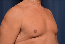 Male Breast Reduction After Photo by Michael Frederick, MD; Fort Lauderdale, FL - Case 35948