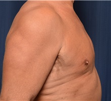 Male Breast Reduction Before Photo by Michael Frederick, MD; Fort Lauderdale, FL - Case 35948