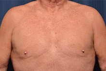 Male Breast Reduction After Photo by Michael Frederick, MD; Fort Lauderdale, FL - Case 35949
