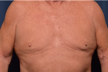 Male Breast Reduction Before Photo by Michael Frederick, MD; Fort Lauderdale, FL - Case 35949