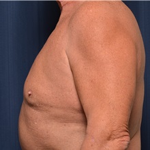 Male Breast Reduction Before Photo by Michael Frederick, MD; Fort Lauderdale, FL - Case 35949