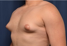 Male Breast Reduction Before Photo by Michael Frederick, MD; Fort Lauderdale, FL - Case 35952